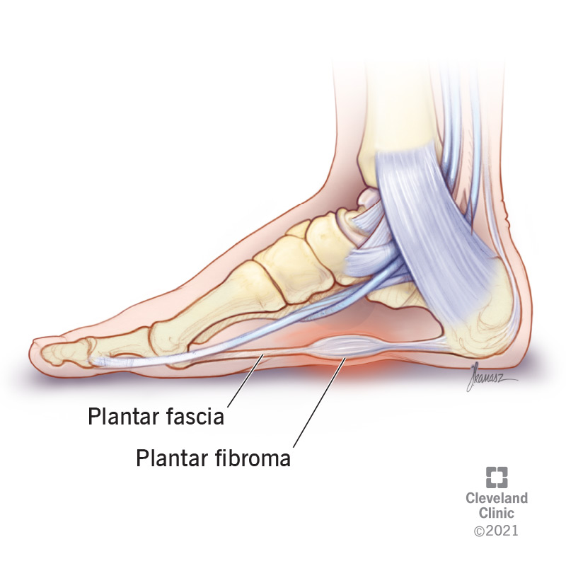 Plantar Fasciitis