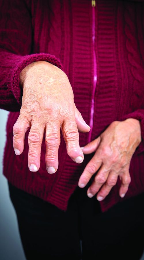 Arthritis Img-2
