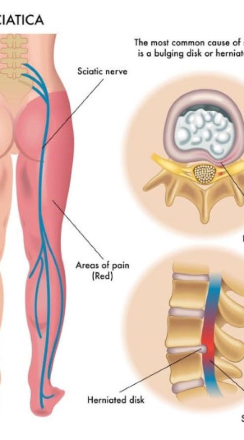 Sciatica-Overview